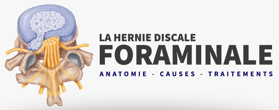 Hernie Discale foraminale : Causes et Traitements
